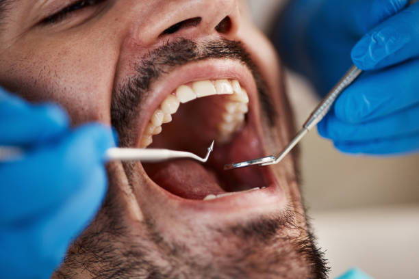 Best Dentist for Tooth Abscess  in Atasdero, CA