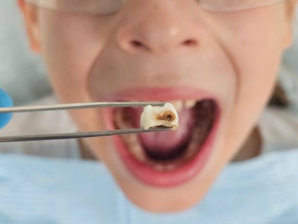 Best Cracked Tooth Emergency Dentist  in Atasdero, CA